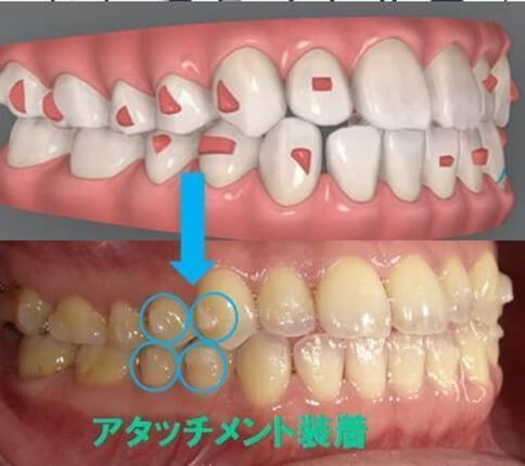 アタッチメント装着