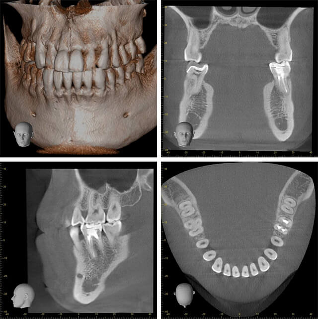 歯科用CT
