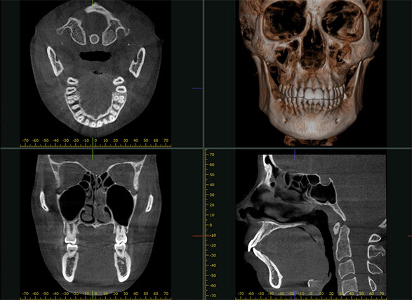 歯科用CT